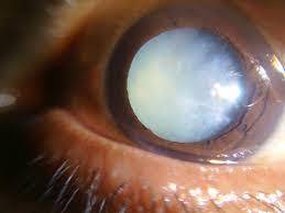 cataract