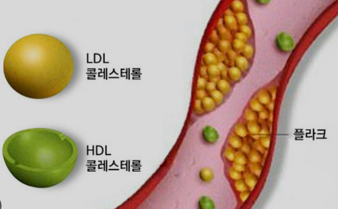 뇌혈관질환