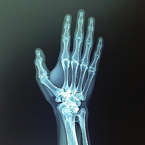 손가락관절염 치료법 및 증상-이미지