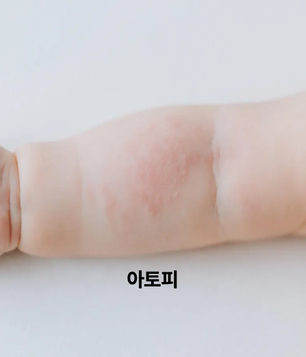 아기-아토피