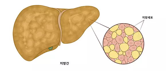 지방간 사진