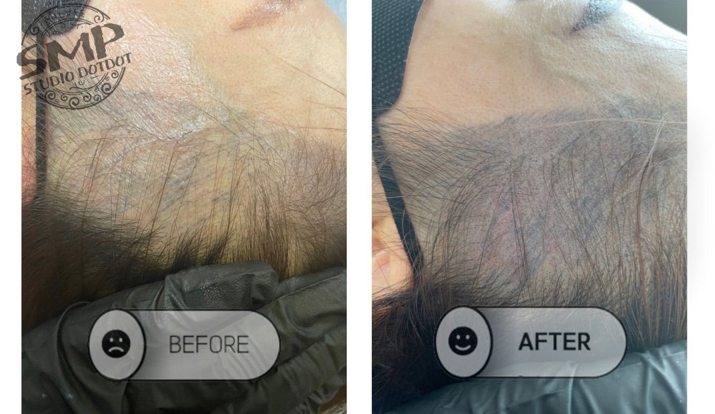 옆머리-두피문신