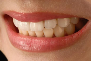 치아 미백, 하얀 치아