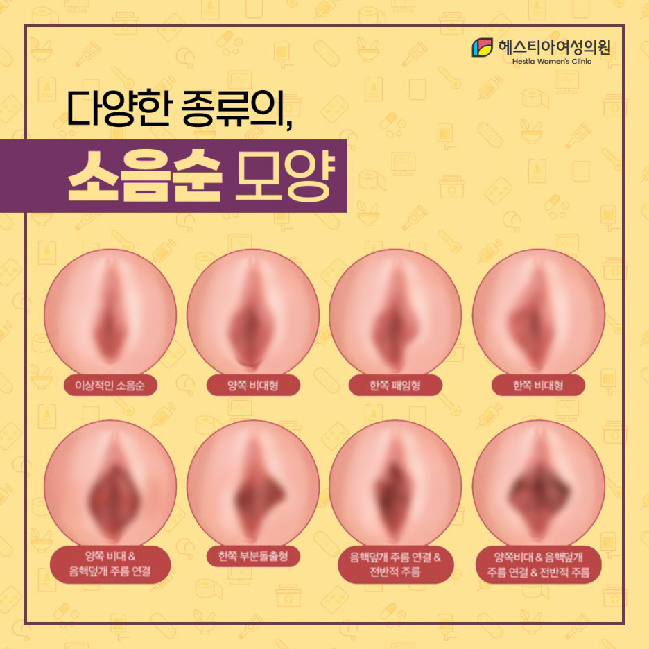 다양한 종류의 소음순 모양