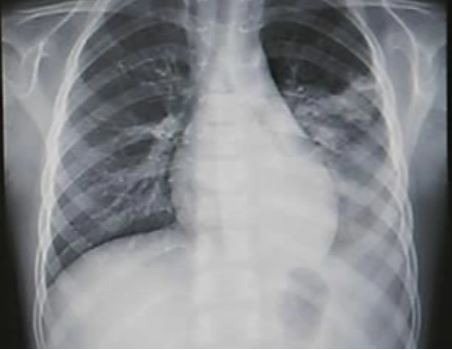 폐렴이 온 폐 x-ray 사진