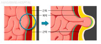 탈장 초기
