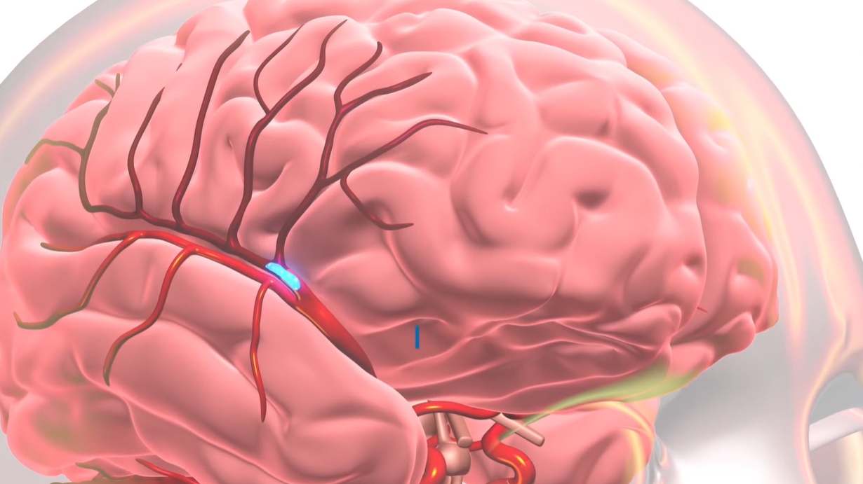 뇌경색 전조증상