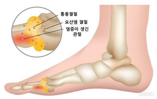 통풍