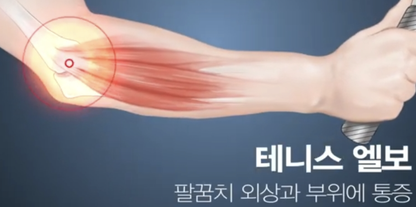 테니니스엘보 정의