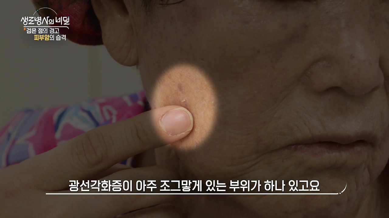 생로병사의 비밀 피부암 검은점