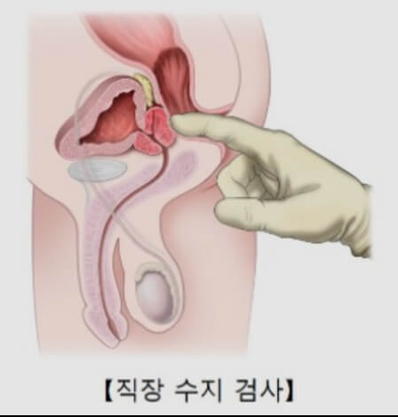 전립선비대증 직장수지검사