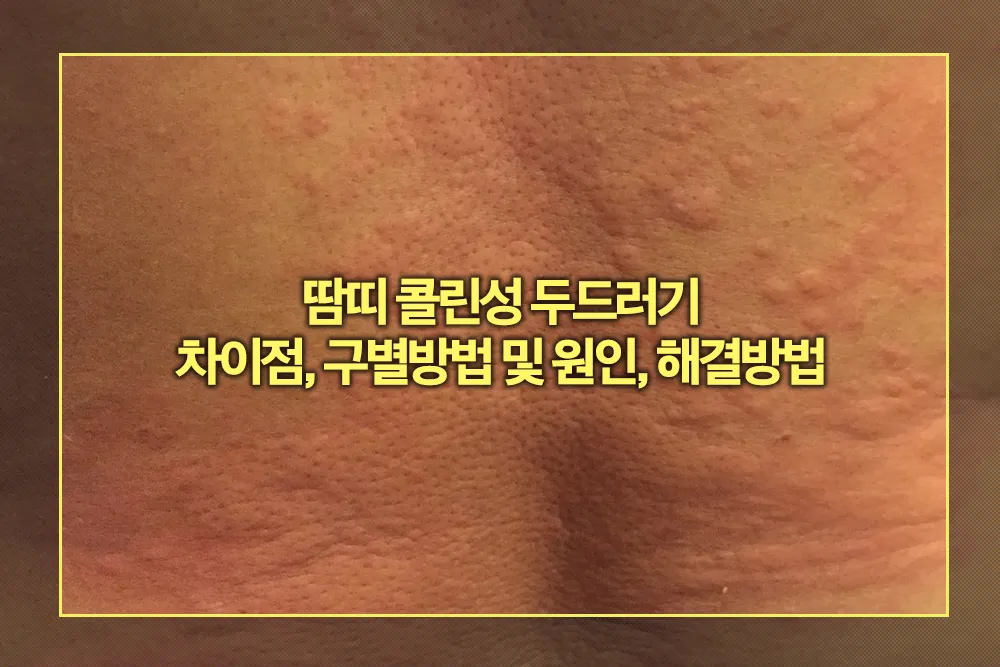 땀띠 콜린성 두드러기 차이점, 구별방법 원인, 해결방법