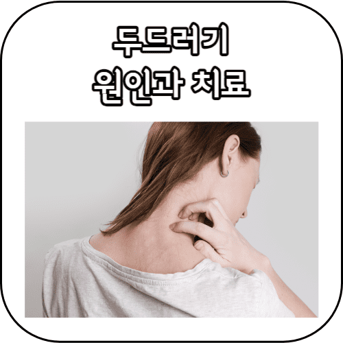 두드러기 원인과 치료