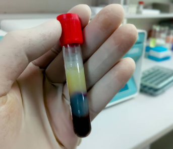 중성지방 낮추는 방법, 중성지방 정상수치