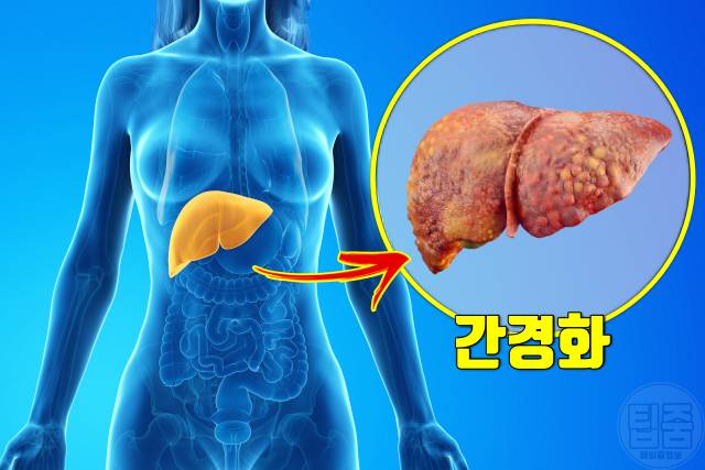 우루사 효능 간영양제 udca 효과 간경화