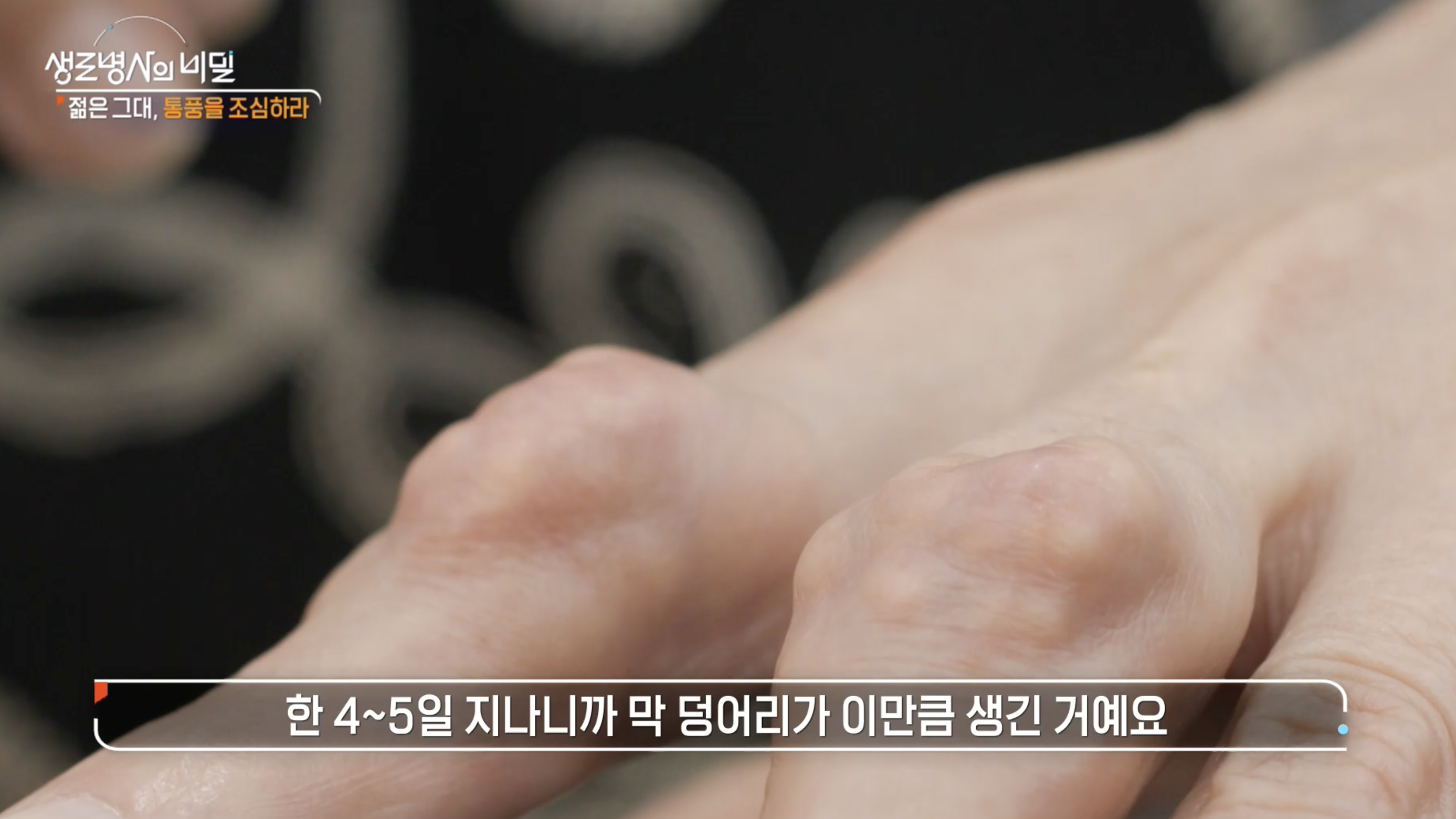 생로병사의 비밀-통풍