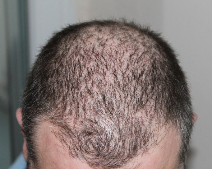 탈모 고민 해결