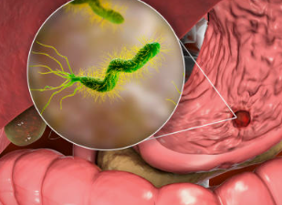 세균성 질환 / 세균성 장염 질염 식중독 이질 뇌수막염 후유증