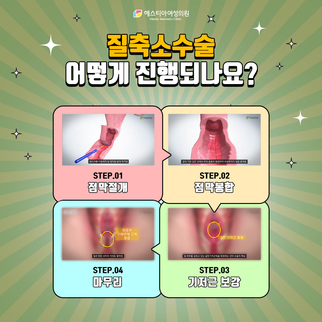 질축소수술 진행 방식은 어떻게 되나요?