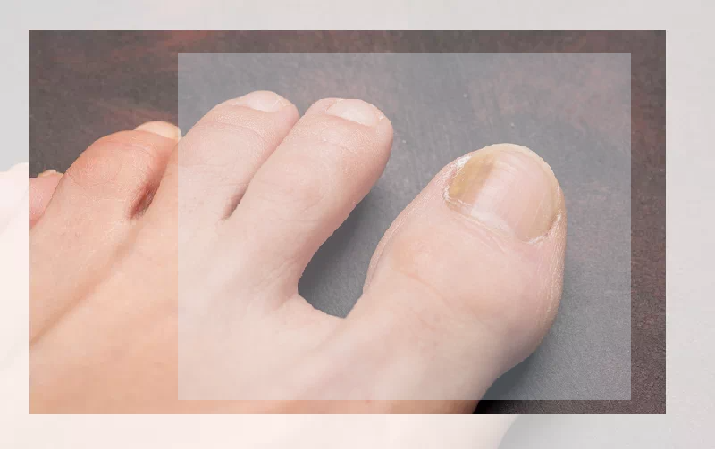 엄지발톱 노란색 변색