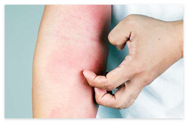 꽃가루 알레르기 증상 가려움증