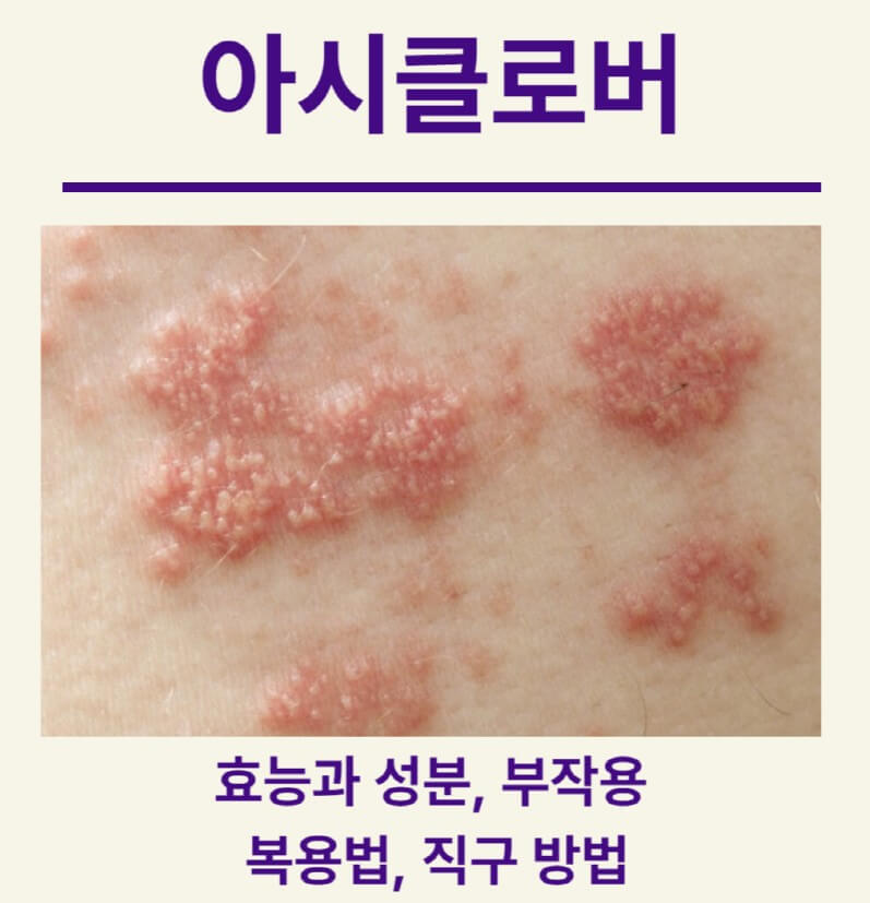 헤르페스로-인해-피부에-수포가-생긴-사진입니다.