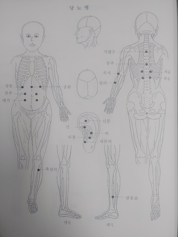 당뇨병