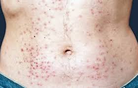 에이즈 HIV 초기증상 치료