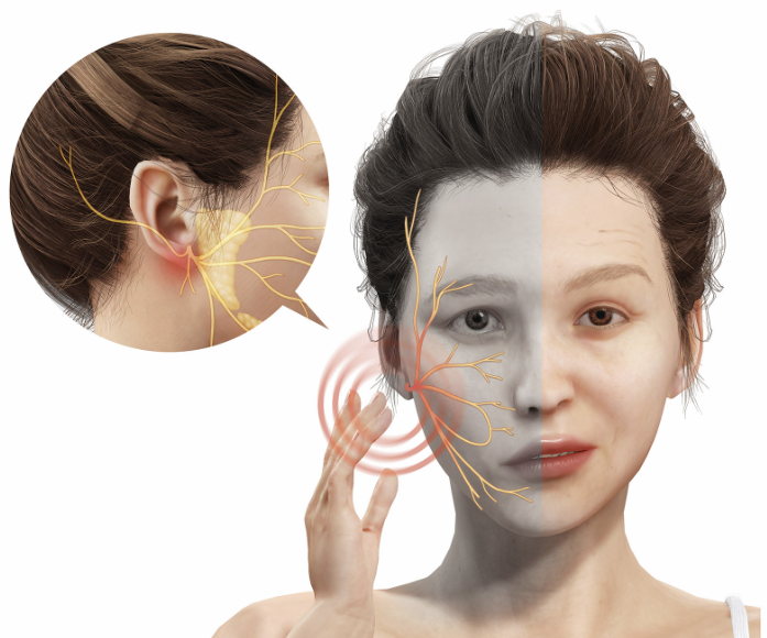 구안와사 증상 이미지