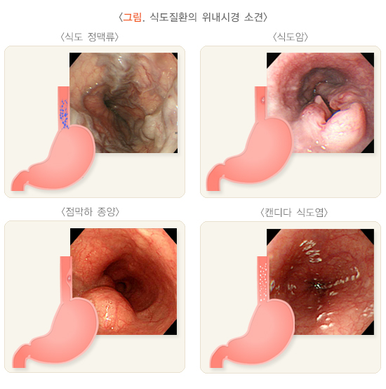 식도질환 위내시경 검사