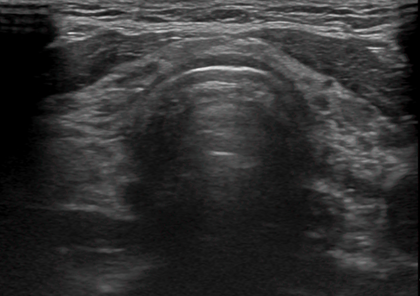 골다공증 증상 원인