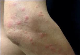 빈대 물린 증상과 치료