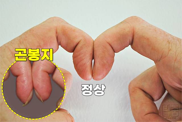 폐 굳는 병 폐섬유증 증상 곤봉지 폐암 전단계 코로나후유증