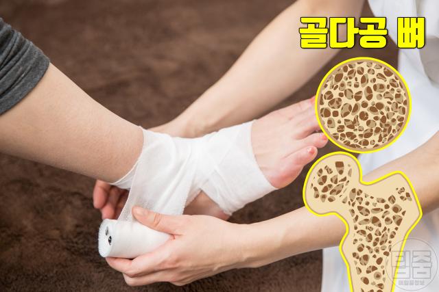 폐경 후 여성 질환 질병 골다공증