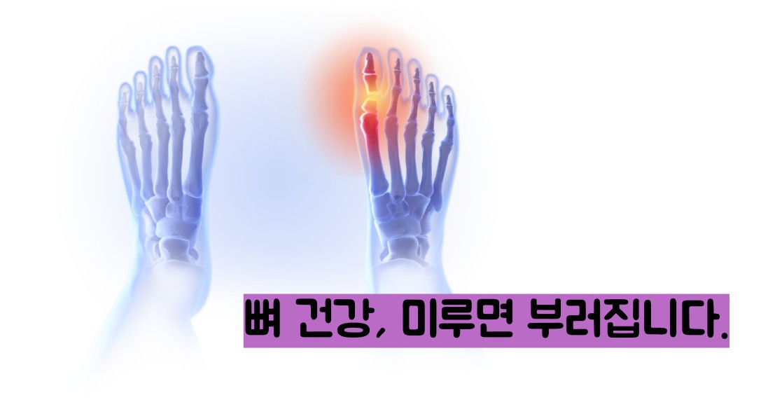 골다공증 수치