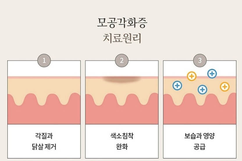 모공각화증 치료 원리를 그림으로 보여줌