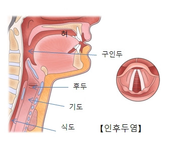 후두염 증상, 원인, 치료