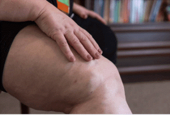 하지 불안 증후군 철분