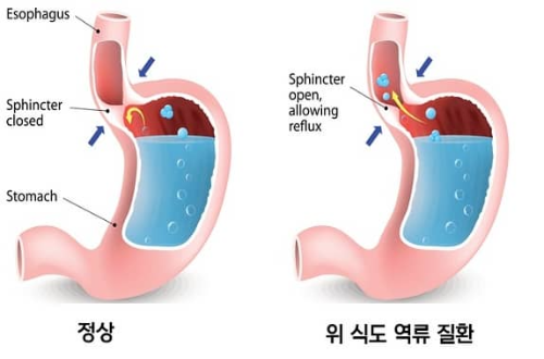 역류성 식도염 이미지