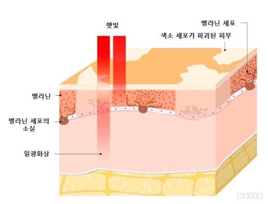 백반증 증상