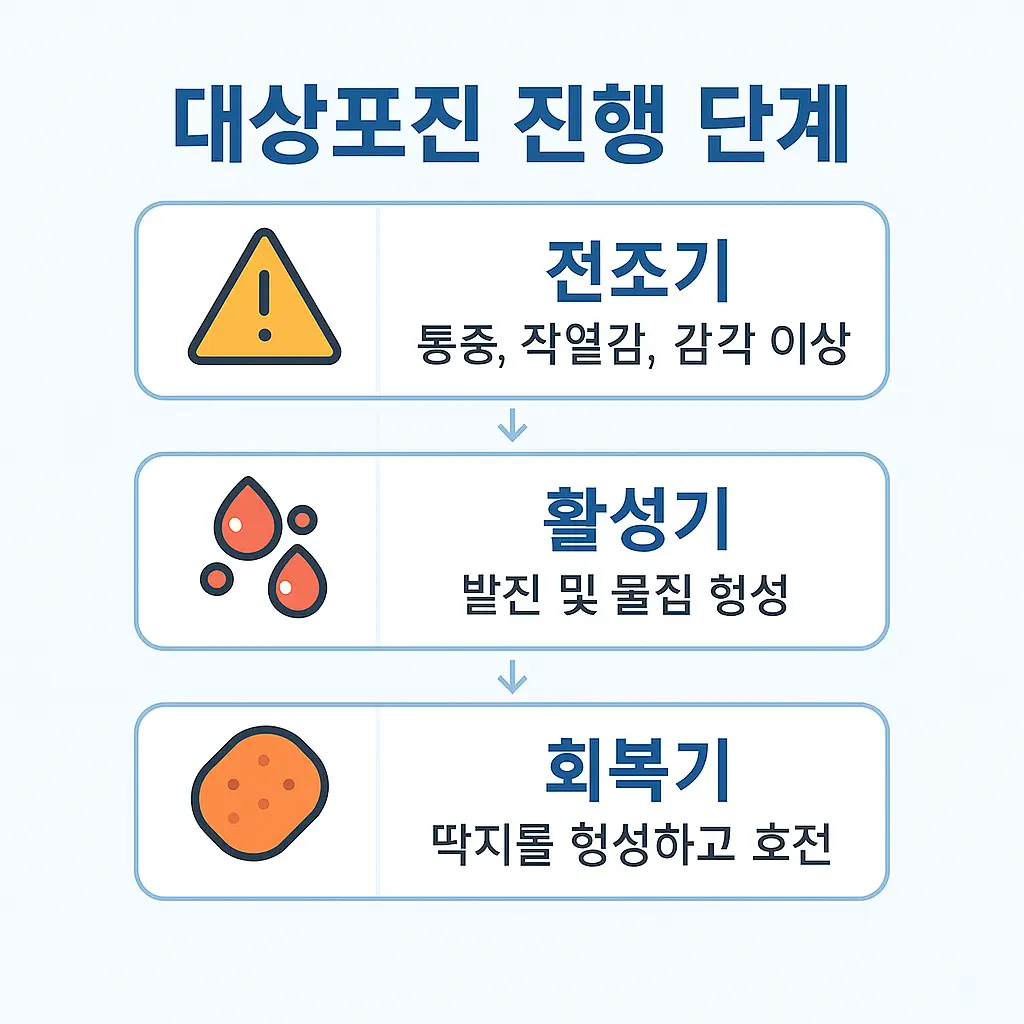 대상포진 진행 단계