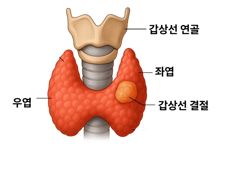 갑상선 결절