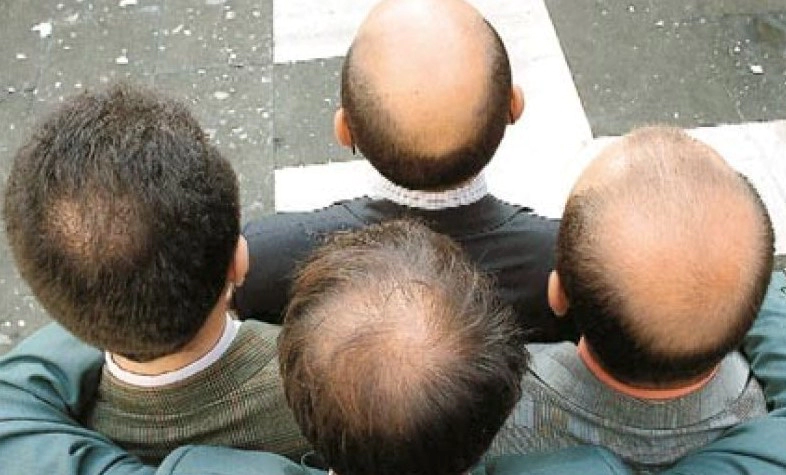 탈모 유전자 종류