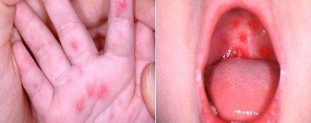 수족구 수포 사진