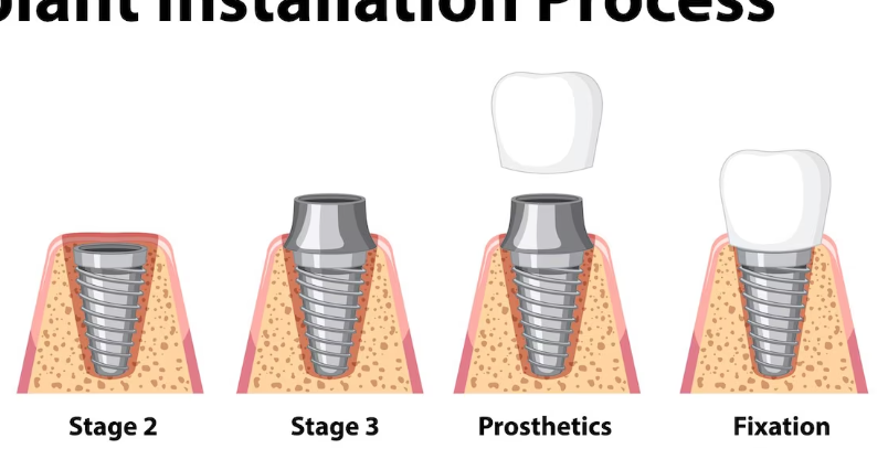 임플란트주의사항