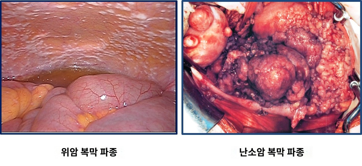 복막파종 전이 복강항암제 치료