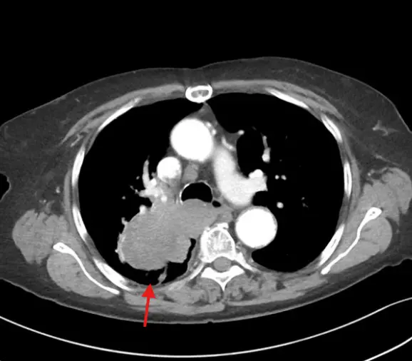 small cell carcinoma