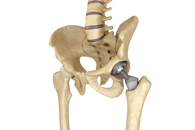 고관절 통증 증상