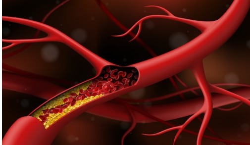 혈관 속에 찌끄러기가 쌓여서 발생되는 동맥경화증을 표현하는 혈관 속 사진