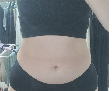 복부지방흡입 후기